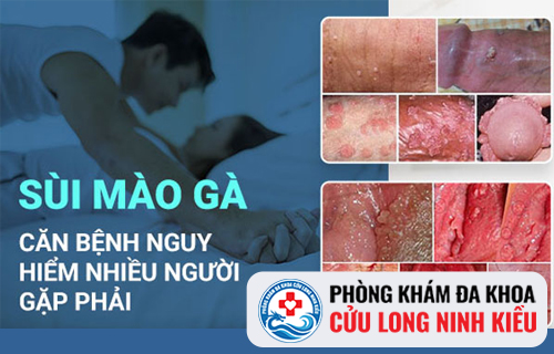 Triệu chứng sùi mào gà cần lưu ý