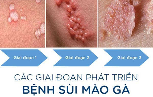 Chú ý các dấu hiệu sùi mào gà