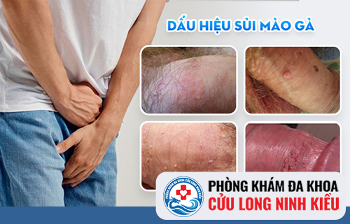 Nhận biết sớm căn bệnh sùi mào gà nguy hiểm