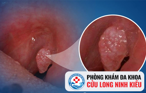 Sống dở chết dở vì sùi mào gà ở họng