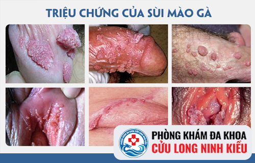 Biểu hiện sùi mào gà cần lưu ý