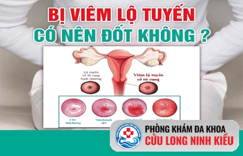 Đốt viêm lộ tuyến cổ tử cung