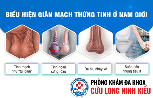 Dấu hiệu của giãn tĩnh mạch thừng tinh