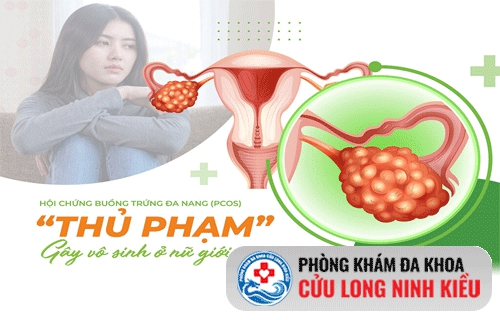 Nguyên nhân gây buồng trứng đa nang