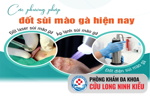 Tìm hiểu về phương pháp đốt sùi mào gà