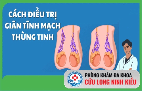 Điều trị bệnh giãn tĩnh mạch thừng tinh ở nam giới
