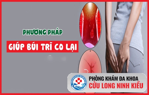 Làm thế nào để búi trĩ co lên?