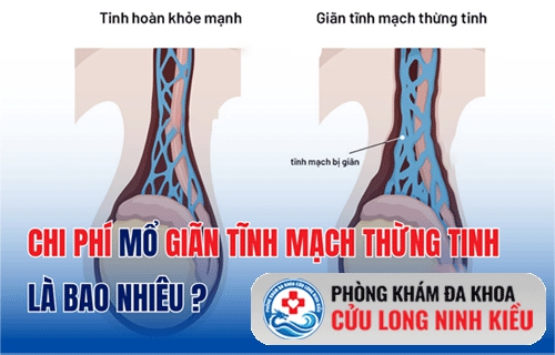 Chi phí chữa giãn mạch thừng tinh