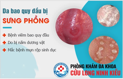 Bao quy đầu bị sưng phồng lên như cục mỡ là do đâu ?