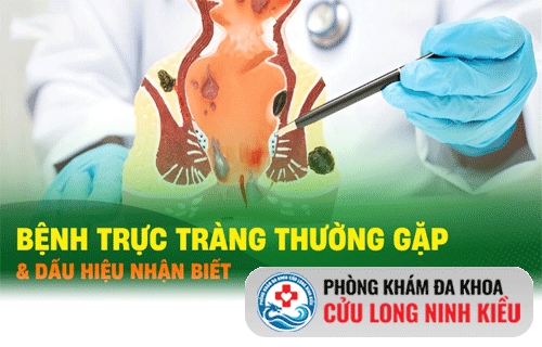 Dấu hiệu nhận biết bệnh hậu môn trực tràng thường gặp