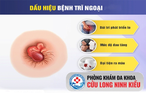 Biểu hiện của bệnh trĩ ngoại