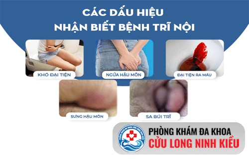Biểu hiện của bệnh trĩ nội