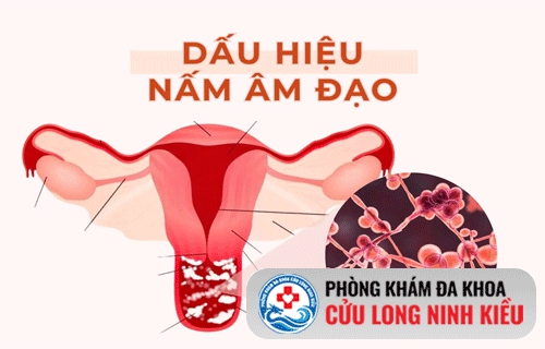 Những điều cần biết về nấm vùng kín