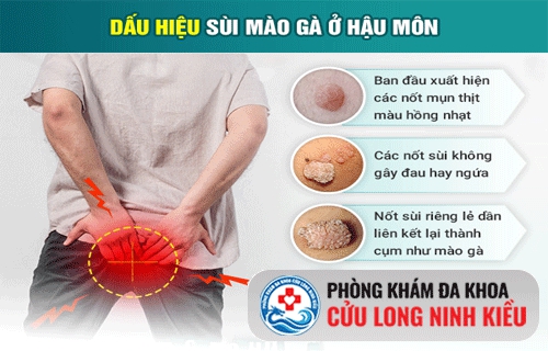 Biểu hiện sùi mào gà ở hậu môn