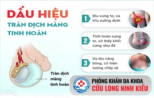 Dấu hiệu nhận biết tràn dịch màng tinh hoàn