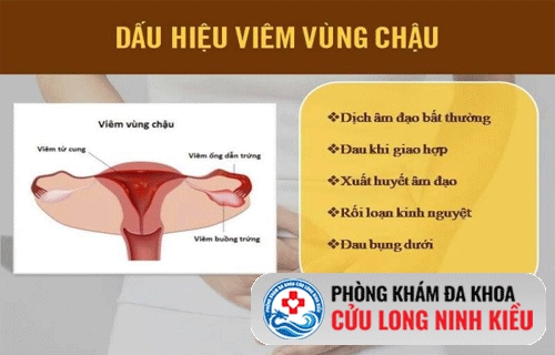 Dấu hiệu nhận biết viêm vùng chậu sớm nhất