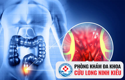 Những nguyên nhân dẫn đến đi cầu ra máu