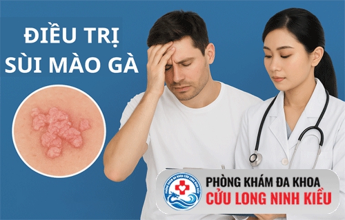 Điều trị sùi mào gà