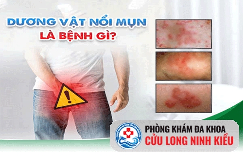 Nổi mụn ở dương vật