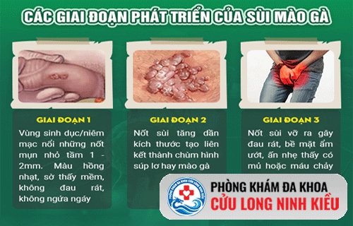 Hình ảnh siêu thực về các giai đoạn phát triển của sùi mào gà