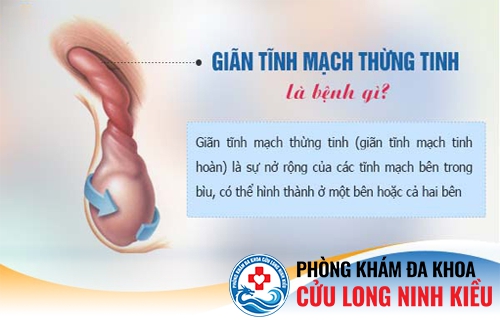 Giãn tĩnh mạch tinh hoàn là bệnh gì?