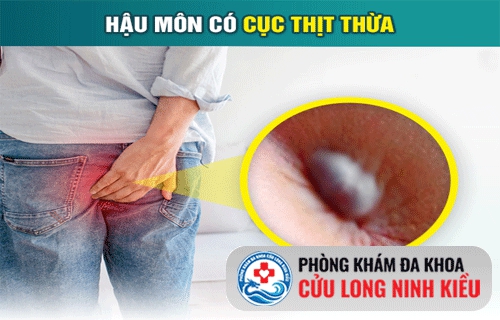 Sưng cục to ở hậu môn làm sao hết