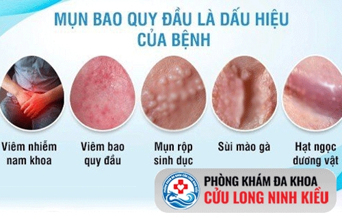 Mọc mụn ở bao quy đầu có nguy hiểm không?