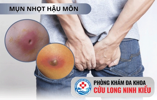 Nổi mụn nhọt ở hậu môn là bệnh gì?