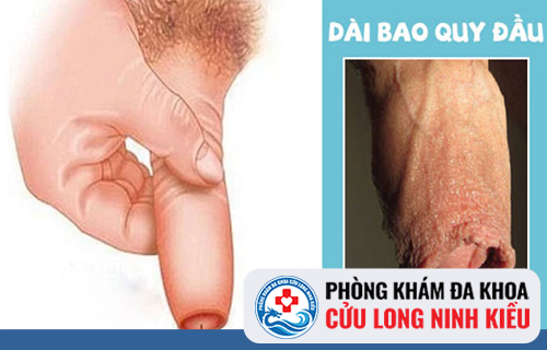 Dấu hiệu dài bao quy đầu nam giới cần lưu ý
