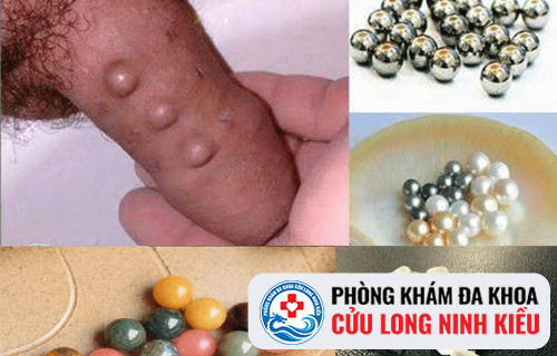 Gắn bi vào dương vật bao lâu mới quan hệ được?