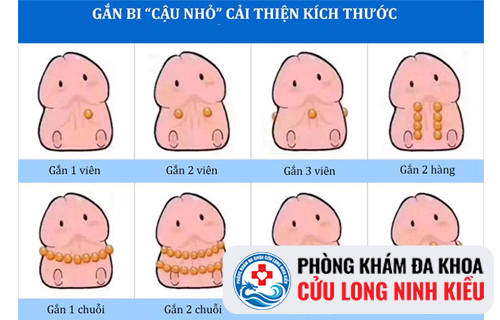 Mất bao nhiêu tiền mới có thể tiến hành gắn bi dương vật?