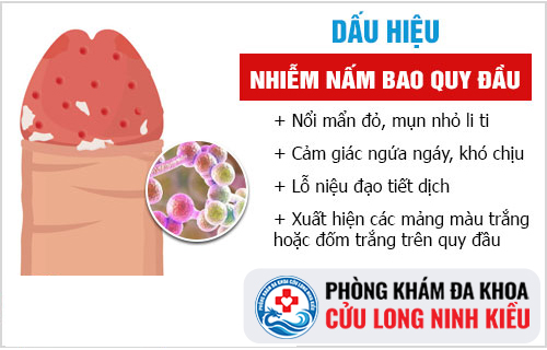 Thực phẩm chức năng hỗ trợ trị nấm bao quy đầu hiệu quả