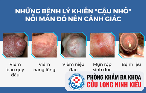 Triệu chứng mẩn đỏ quy đầu nguy hiểm nam giới nên biết