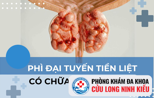 Phương pháp nào điều trị phì đại tuyến tiền liệt hiệu quả?