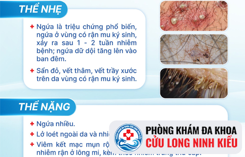 Bệnh rận mu và những điều cần biết