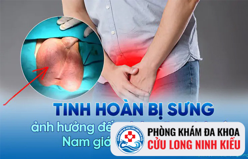 Sưng tinh hoàn trái là dấu hiệu của bệnh gì?