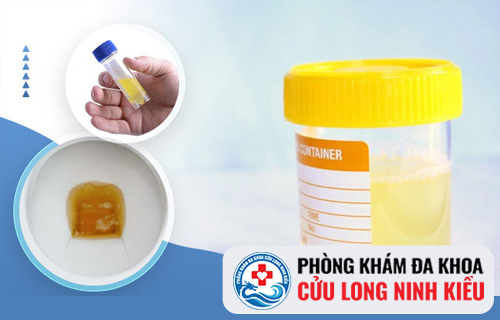 Nước tiểu đục là dấu hiệu của bệnh lý gì?