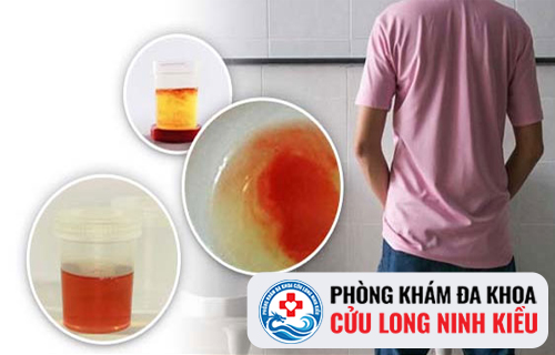 Điểm danh các nguyên nhân tiểu ra máu chính xác nhất