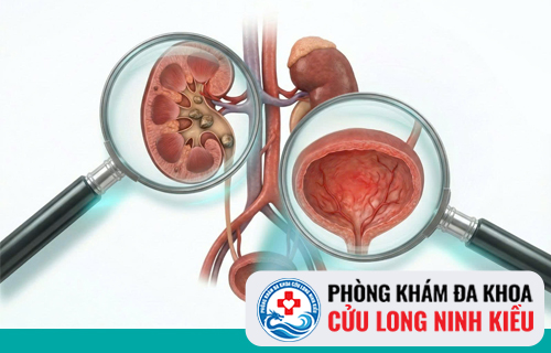 Tiểu rát là dấu hiệu của bệnh gì?