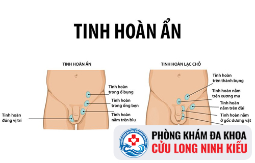 Tinh Hoàn Ẩn Tăng Nguy Cơ Ung Thư tinh hoàn Và Vô Sinh