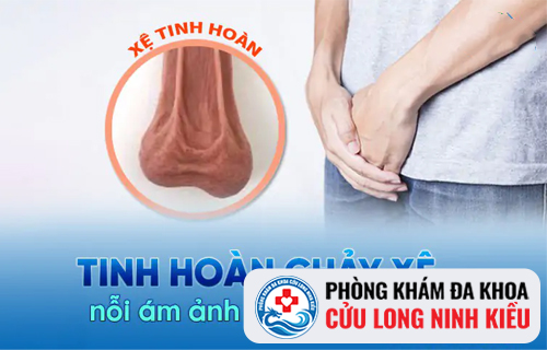 Tinh hoàn chảy xệ do những nguyên nhân nào?