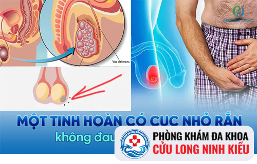 Cảnh báo các bệnh nguy hiểm khi tinh hoàn nổi cục cứng