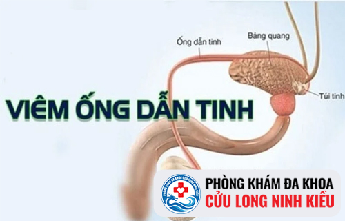 Dấu hiệu nhận biết của bệnh viêm ống dẫn tinh