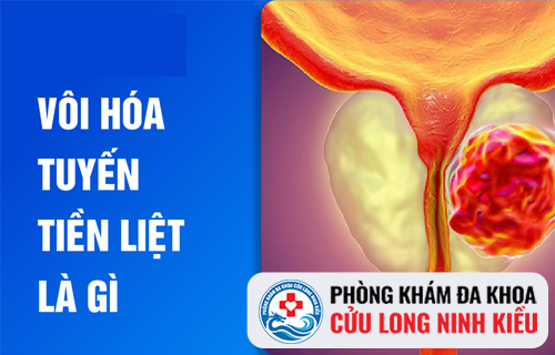 Bệnh vôi hóa tuyến tiền liệt có chữa được không?