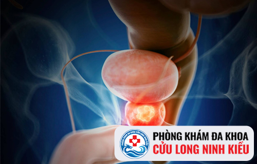 Vôi Hóa tuyến tiền liệt Nguy Hiểm Như Thế Nào?
