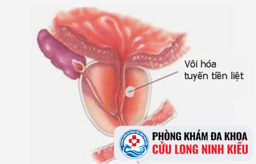 Trị vôi hóa tuyến tiền liệt