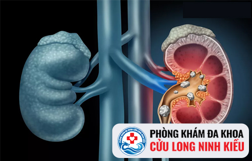 Bệnh vôi hóa tuyến tiền liệt là gì ?