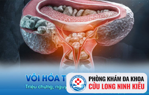Vôi hóa tuyến tiền liệt là gì?