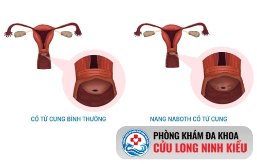 Nang Naboth cổ tử cung là bệnh gì?