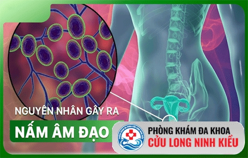 Nấm âm đạo và nguyên nhân gây bệnh